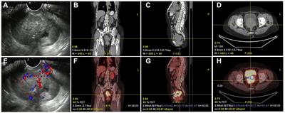 Gastric-type endocervical adenocarcinoma: a case report and literature review